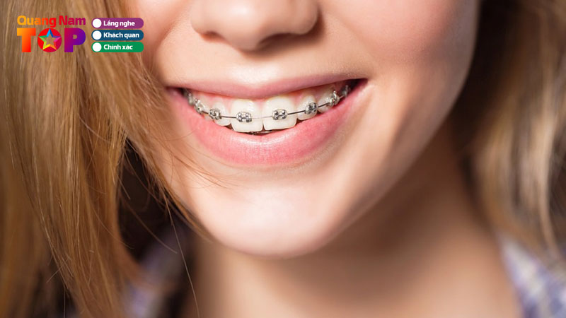 Top-10-dia-chi-nieng-rang-o-quang-nam-dep-co-tra-gop-quangnamtoplist