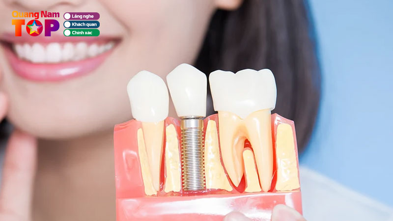 Top-10-dia-chi-trong-rang-o-quang-nam-uy-tin-an-toan-nhat-quangnamtoplist