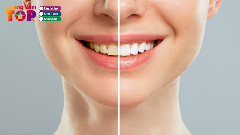 Top-11-nha-khoa-tay-trang-rang-tai-quang-nam-trang-sang-khong-dau-quangnamtoplist